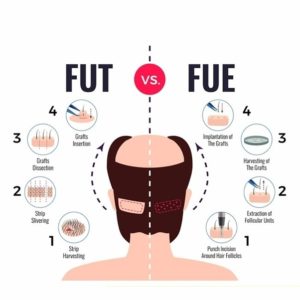 fut vs fue hair transplant