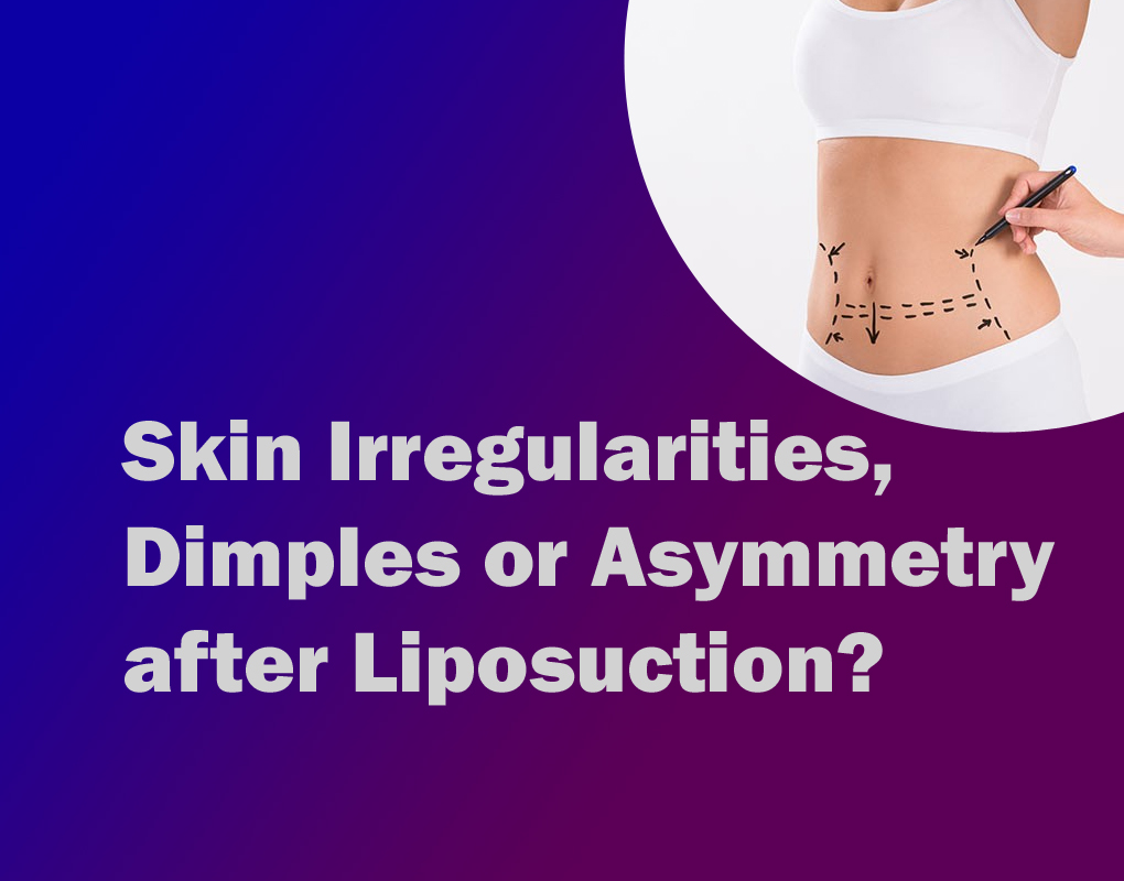Skin Irregularities, Dimples or Asymmetry after Liposuction?