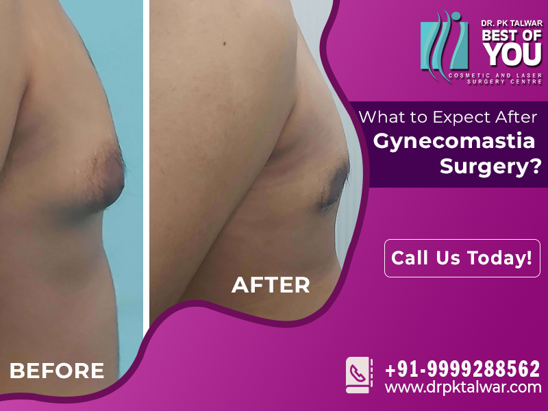 What to Expect After Gynecomastia Surgery?