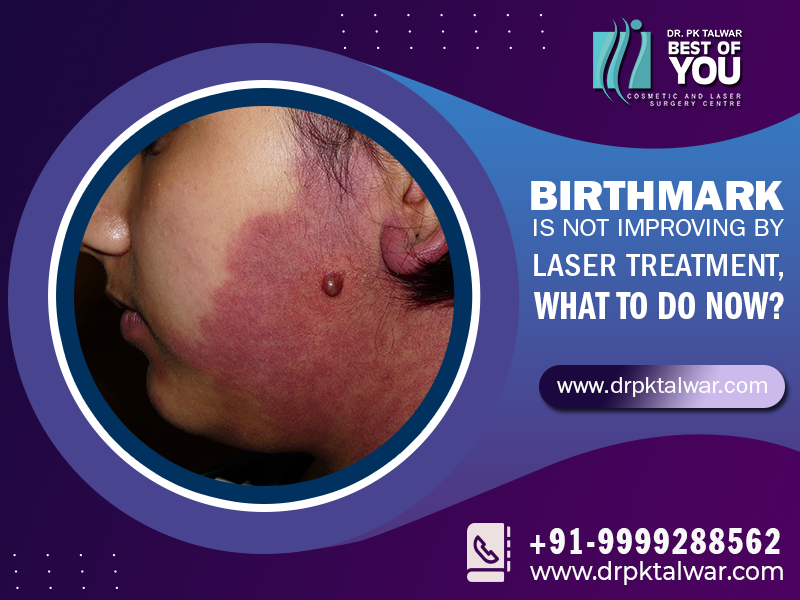 https://www.drpktalwar.com/blog/treatment-of-birthmark-removal-for-kids/