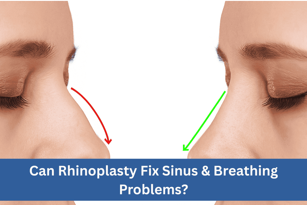 Can Rhinoplasty Fix Sinus & Breathing Problems?