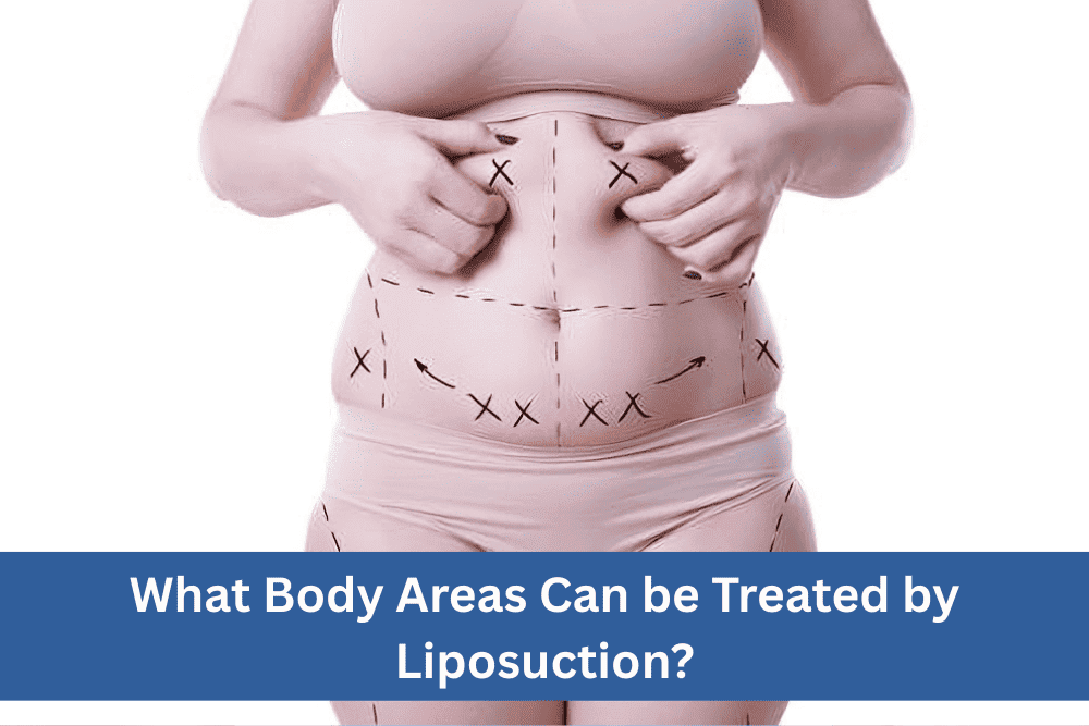 What Body Areas Can Be Treated by Liposuction?