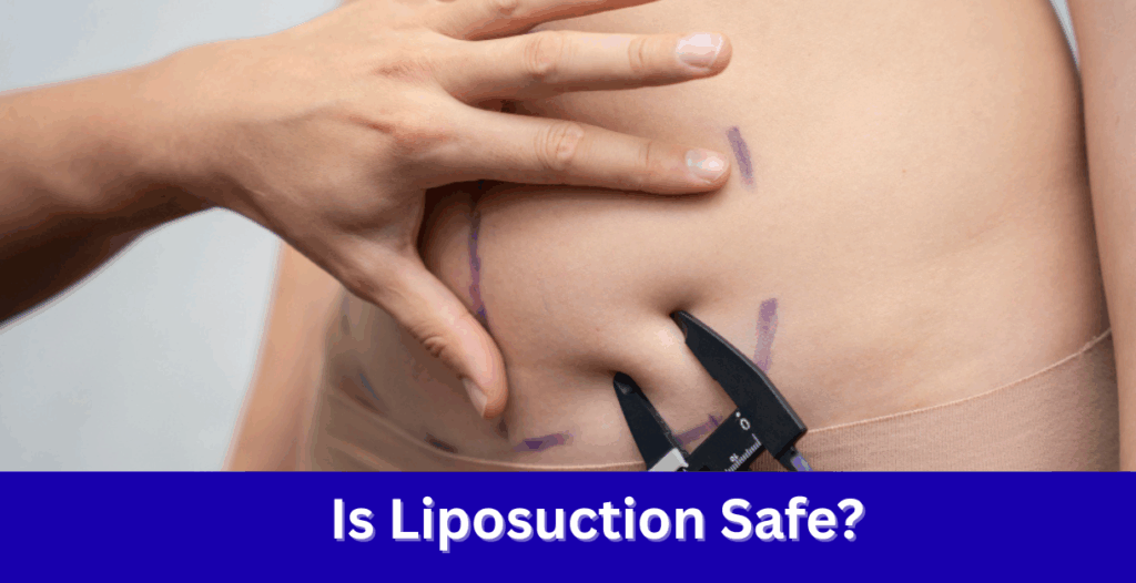 Liposuction Surgery in Delhi