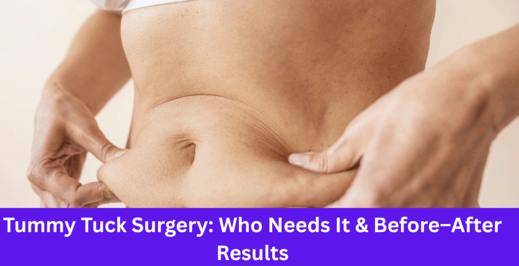 tummy tuck before and after