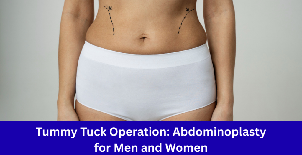 abdominoplasty tummy tuck